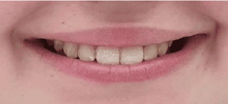 invisalign overbite before and after: after image