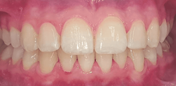 invisalign overbite before and after: close-up after image