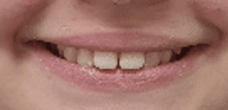 invisalign overbite before and after: before image