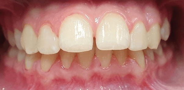 invisalign overbite before and after: close-up before image